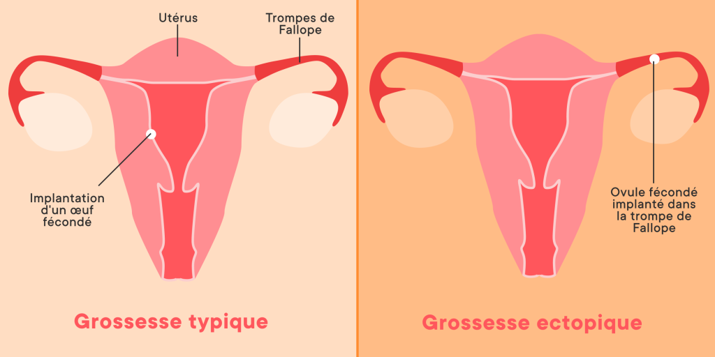 Comprendre la grossesse ectopique : causes, symptômes et traitements