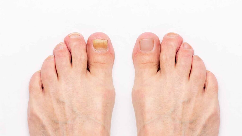 Comment traiter efficacement la mycose de l&rsquo;ongle du pied ?