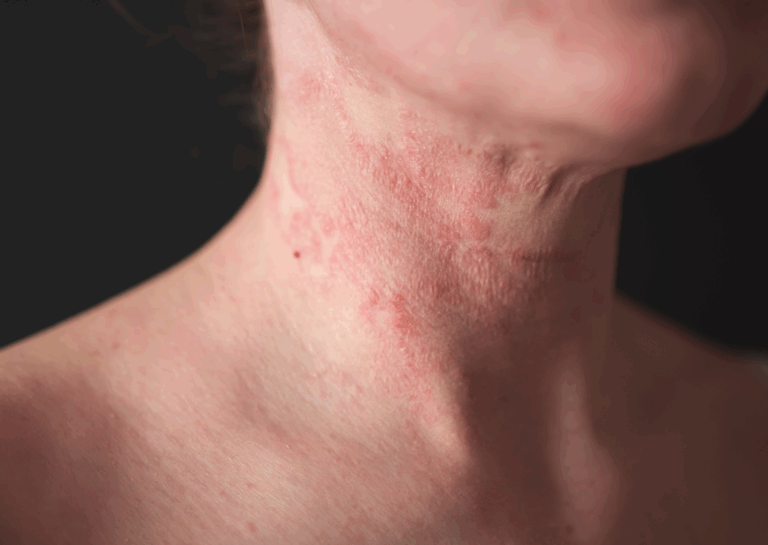 eczema